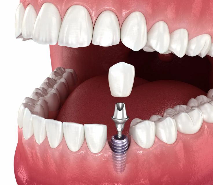 Implantáty a náhrada chybějících zubů